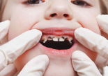 Hàn răng nhiều lần sẽ khiến bạn nhận một kết cục vô cùng đáng sợ