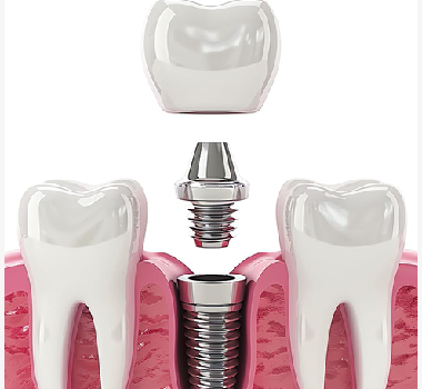 PHỤC HÌNH RĂNG THẨM MỸ