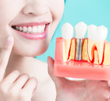 IMPLANT