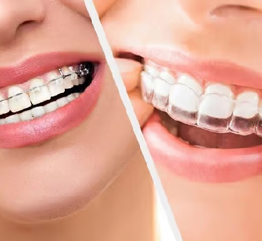 CHỈNH HÌNH RĂNG MẶT